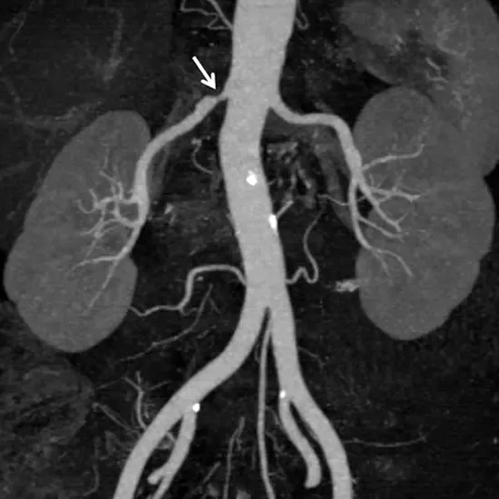 1701165641-Mr angiography renal